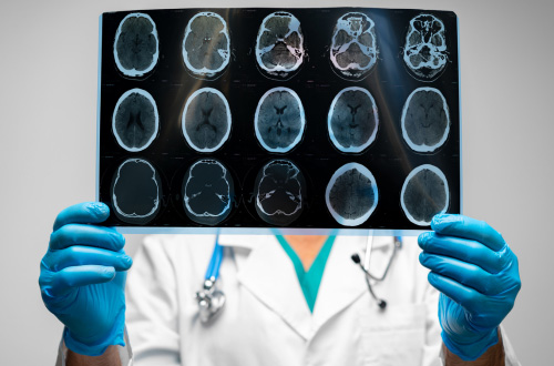 Top 5 Neurology CROs for Brain Research