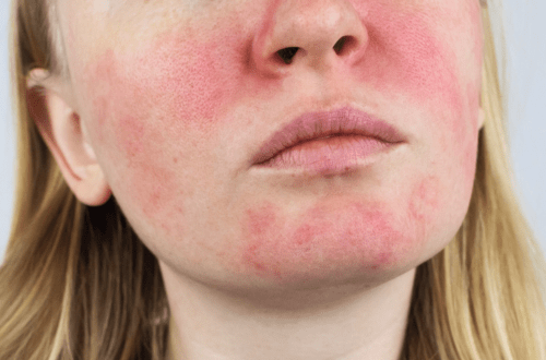 Rosacea: Causes, Symptoms, and Latest Treatment Options