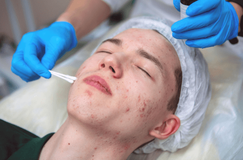 10 Clinical Trials for Acne Research