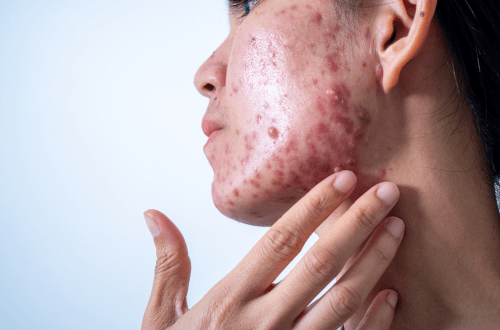 Top 10 CROs for Acne Research