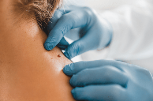 Top 5 Early Signs of Melanoma
