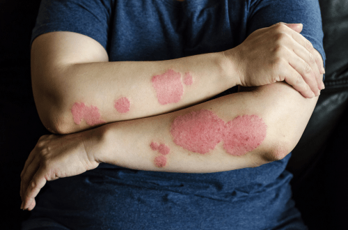 Top-Dermatology-CROs-for-Eczema-Research_featured