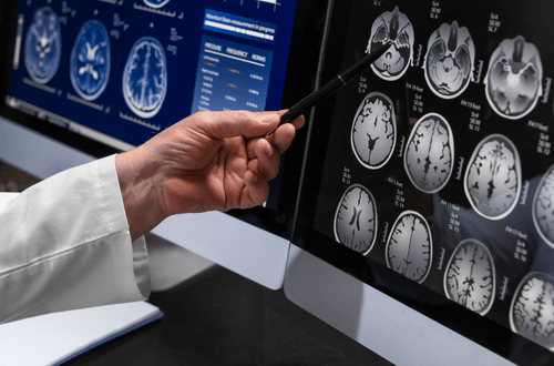 Understanding Neurological Clinical Trial Trends for 2024
